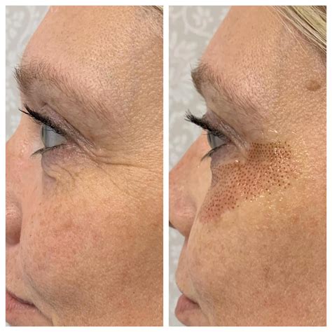 After that, your skin will continue to heal and have the effects of the treatment set in for up to 12 weeks. . Hyperpigmentation after plasma pen